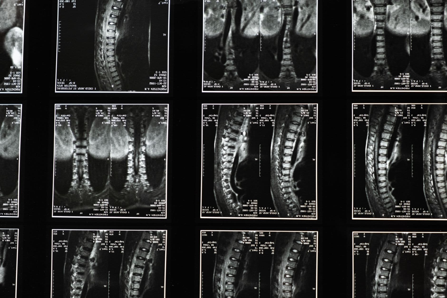 أسئلة شارحة: تحديات تشخيص وعلاج التصلب اللويحي المتعدد (Multiple Sclerosis)