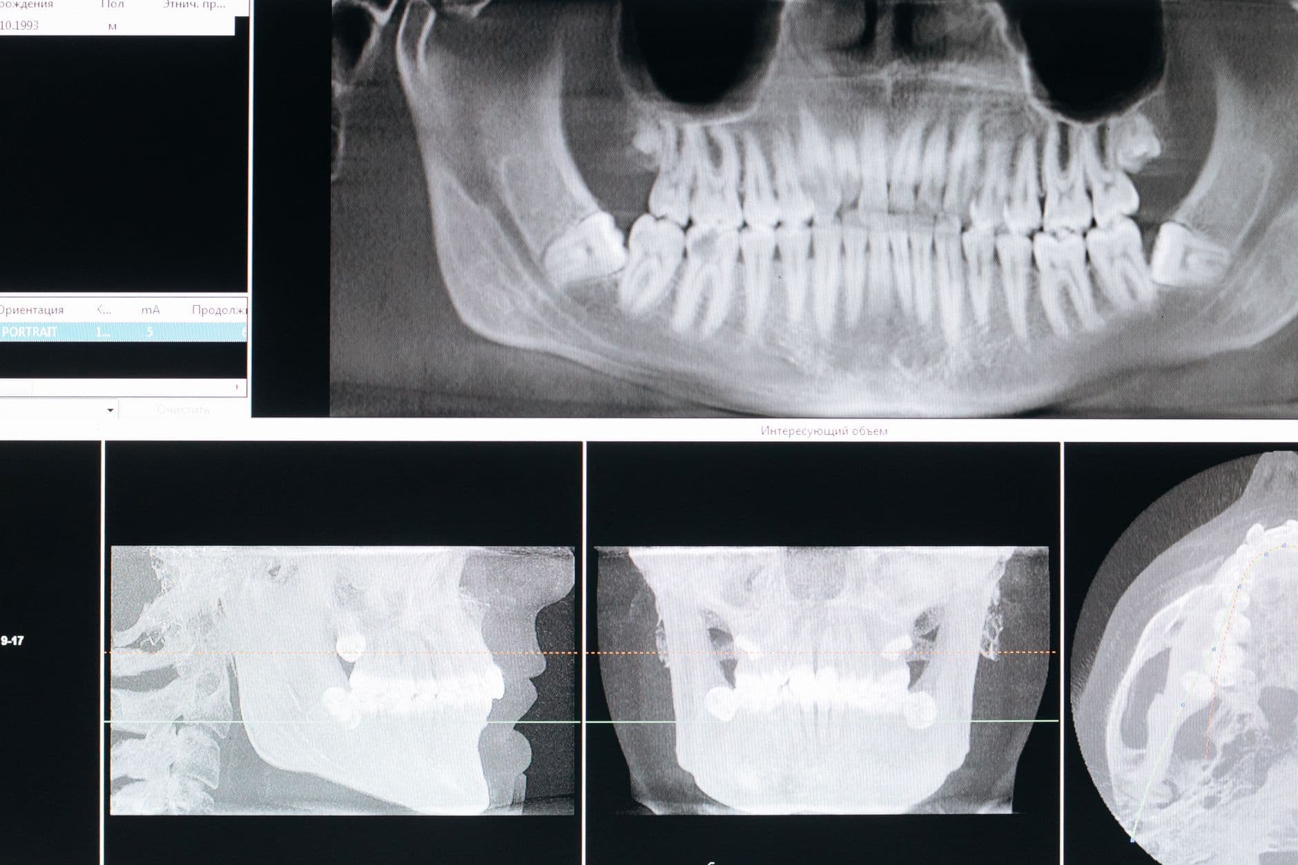 أسئلة شارحة: تحديات تشخيص وعلاج متلازمة ألم المفصل الصدغي الفكي (TMJ Syndrome)